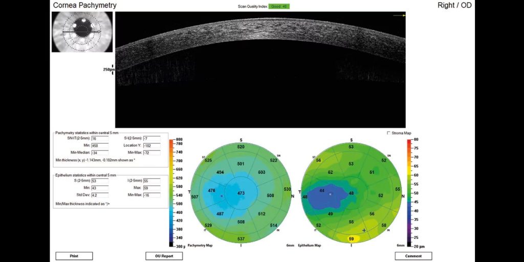 OptoVue iFusion 80 OCT with Fundus Camera | VITOP